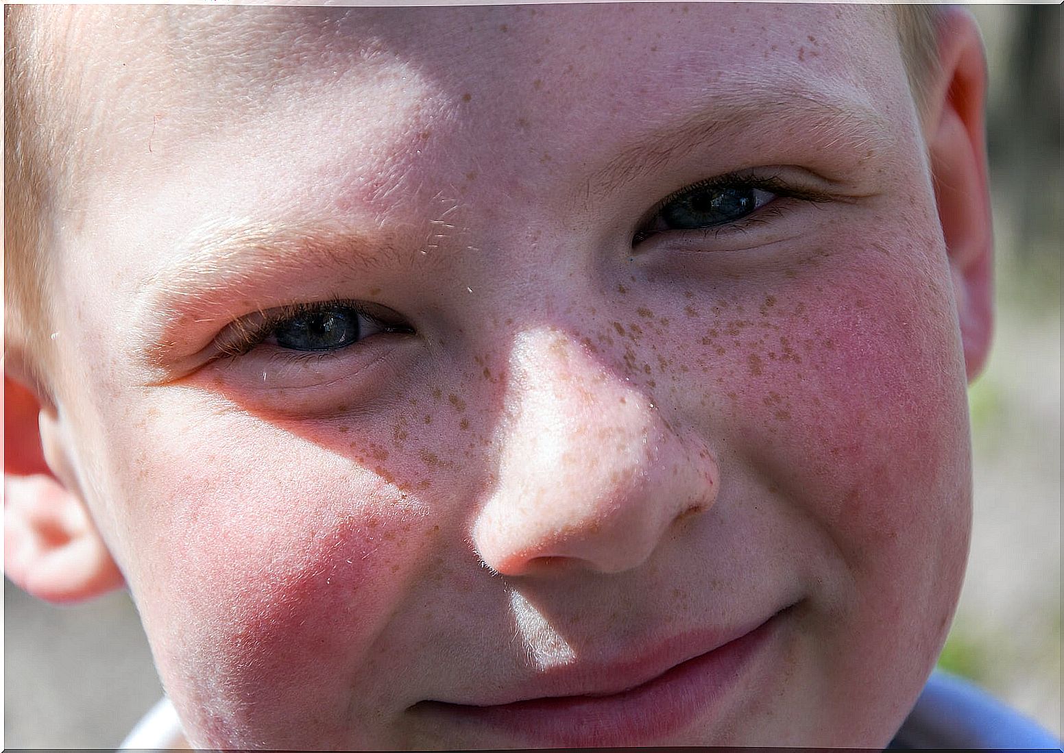 Boy with many freckles on his face.