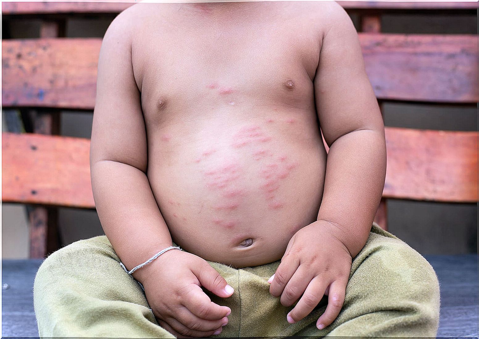 Children with skin allergies: symptoms and recommendations