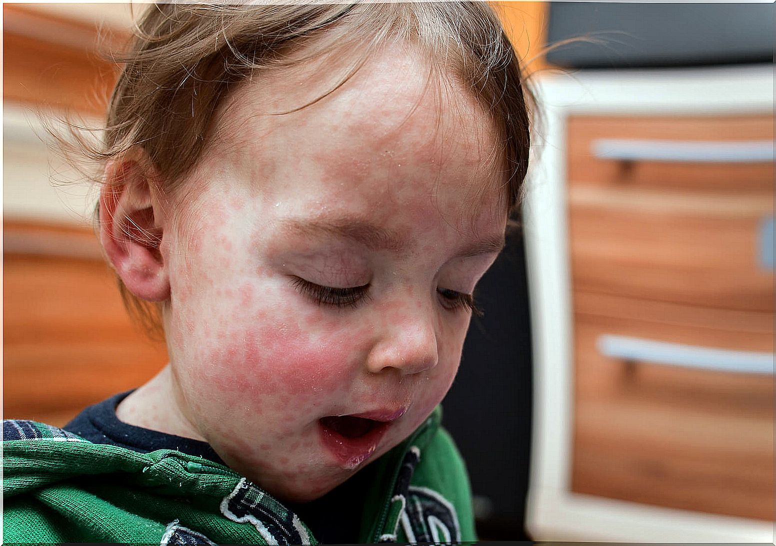 Child with skin allergies.