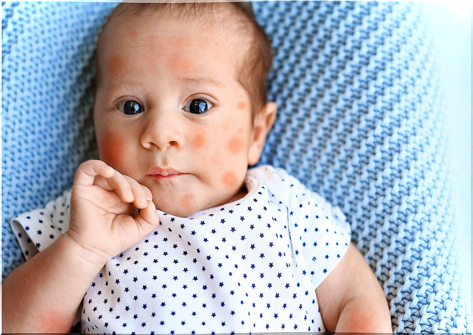 Child with a face full of hives due to an allergy.