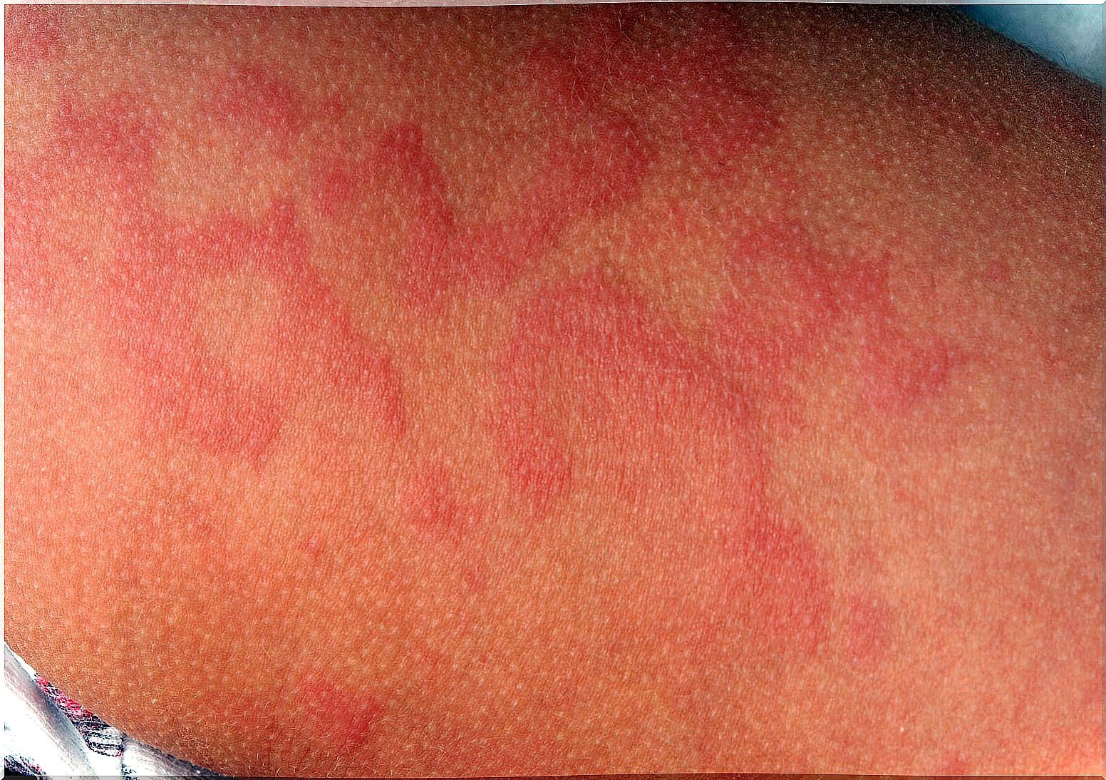 Erythema nodosum in children: symptoms, causes and treatment