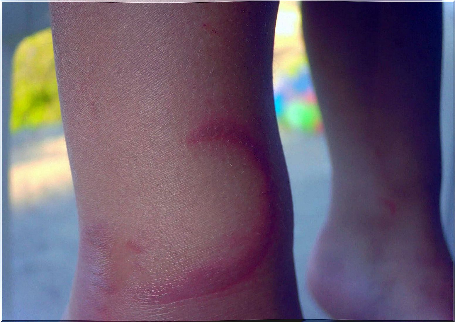 Jellyfish stings in a child.