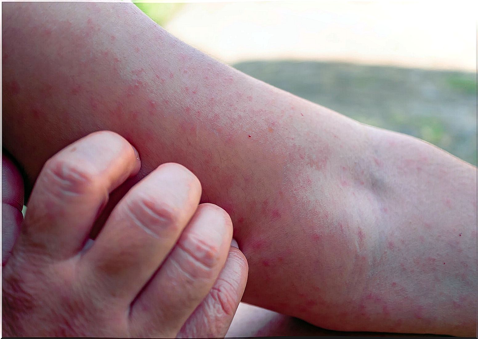 Child with erythema nodosum.