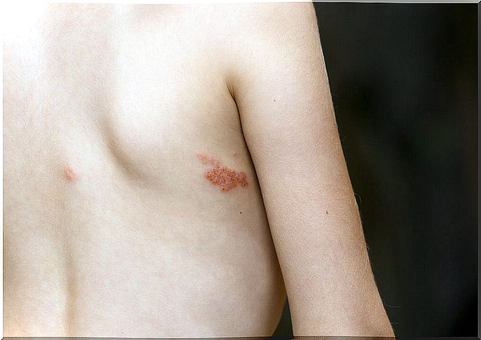 Impetigo in Children: Types, Symptoms, and Treatment