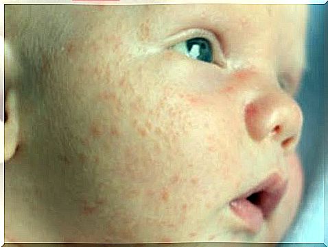 What is infant acne?